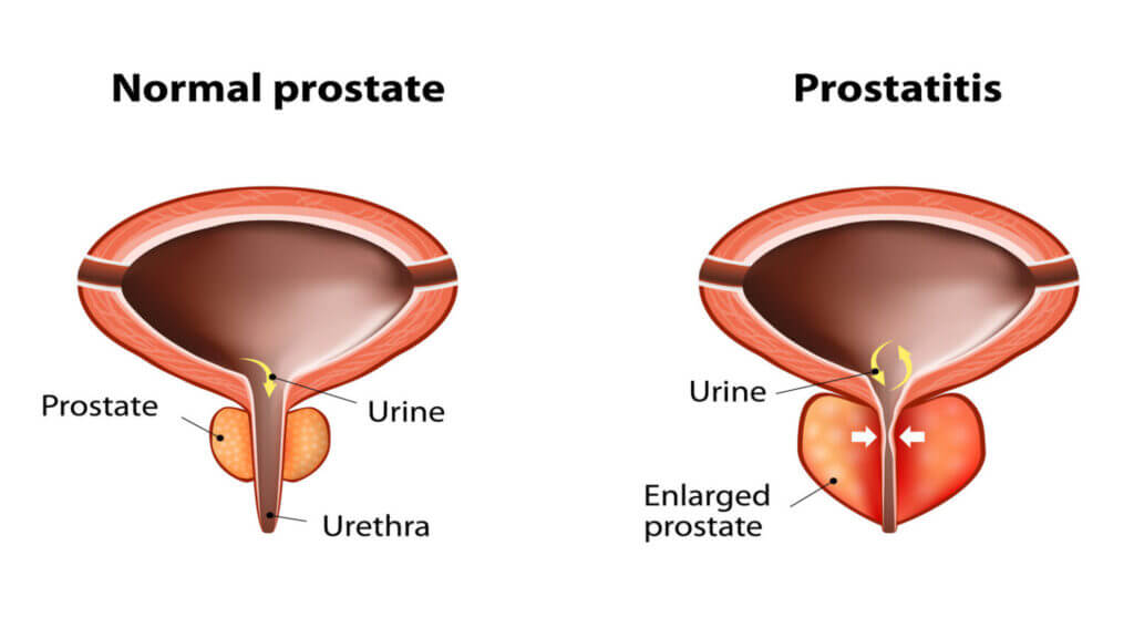 Prostate discomfort illustration